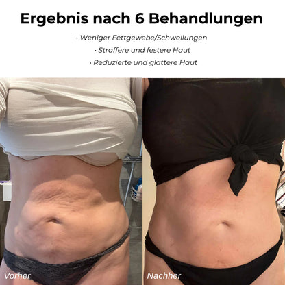 VelaSculpt™ Anti-Cellulite