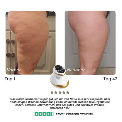 VelaSculpt™ Anti-Cellulite
